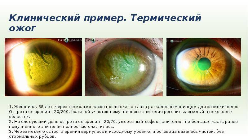 Ожог глаз кварцевой лампой: симптомы и лечение