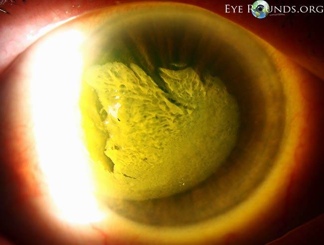 Ожог глаз лампой: симптомы, доврачебная помощь, меры предосторожности